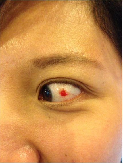 bright red spot eye